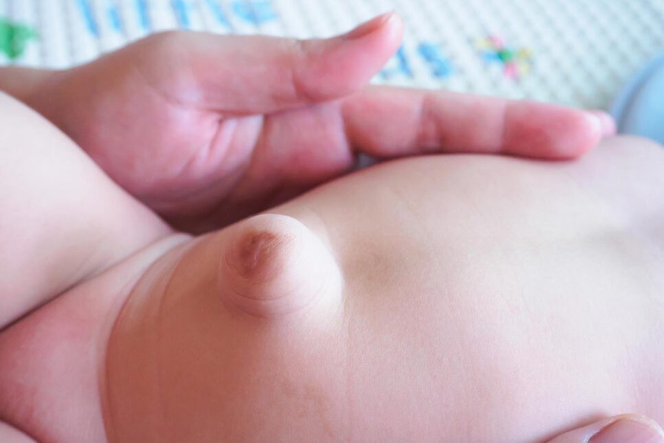 Hernia Umbilical