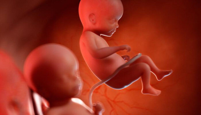 Síndrome transfusión Feto Fetal